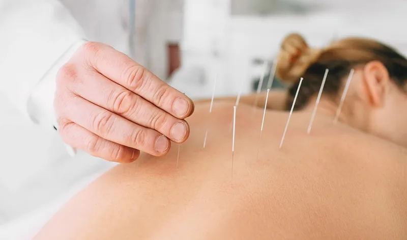¿Qué es la Acupuntura Médica de Alta Especialidad?