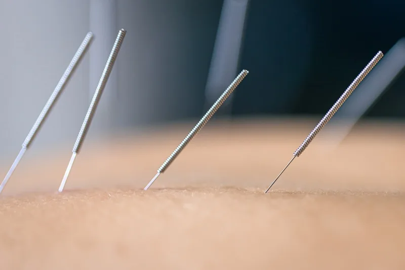 Acupuntura Médica de Alta Especialidad